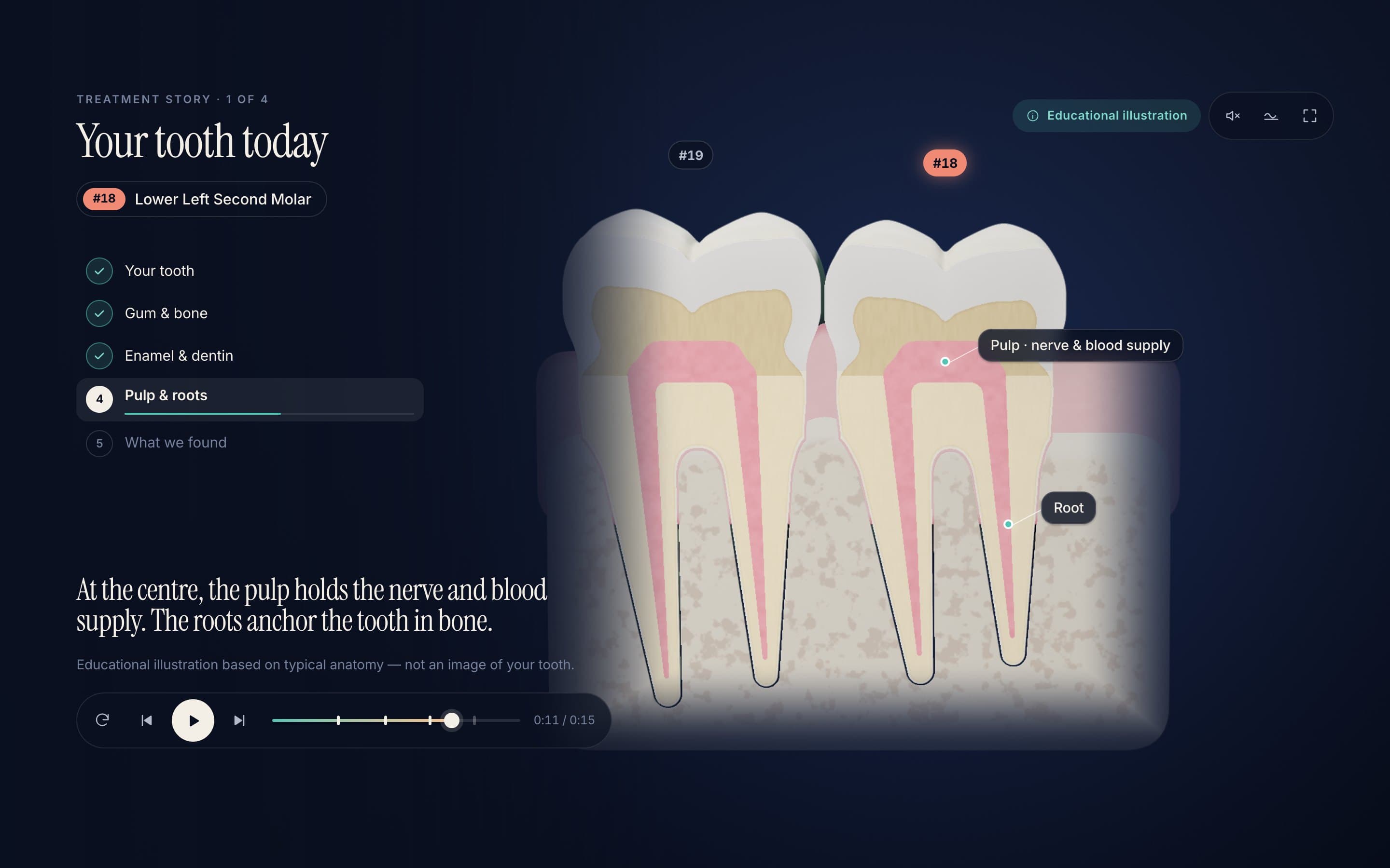 CaseAura presentation showing a 3D cross-section of tooth #18 with enamel, dentin, pulp and roots labelled