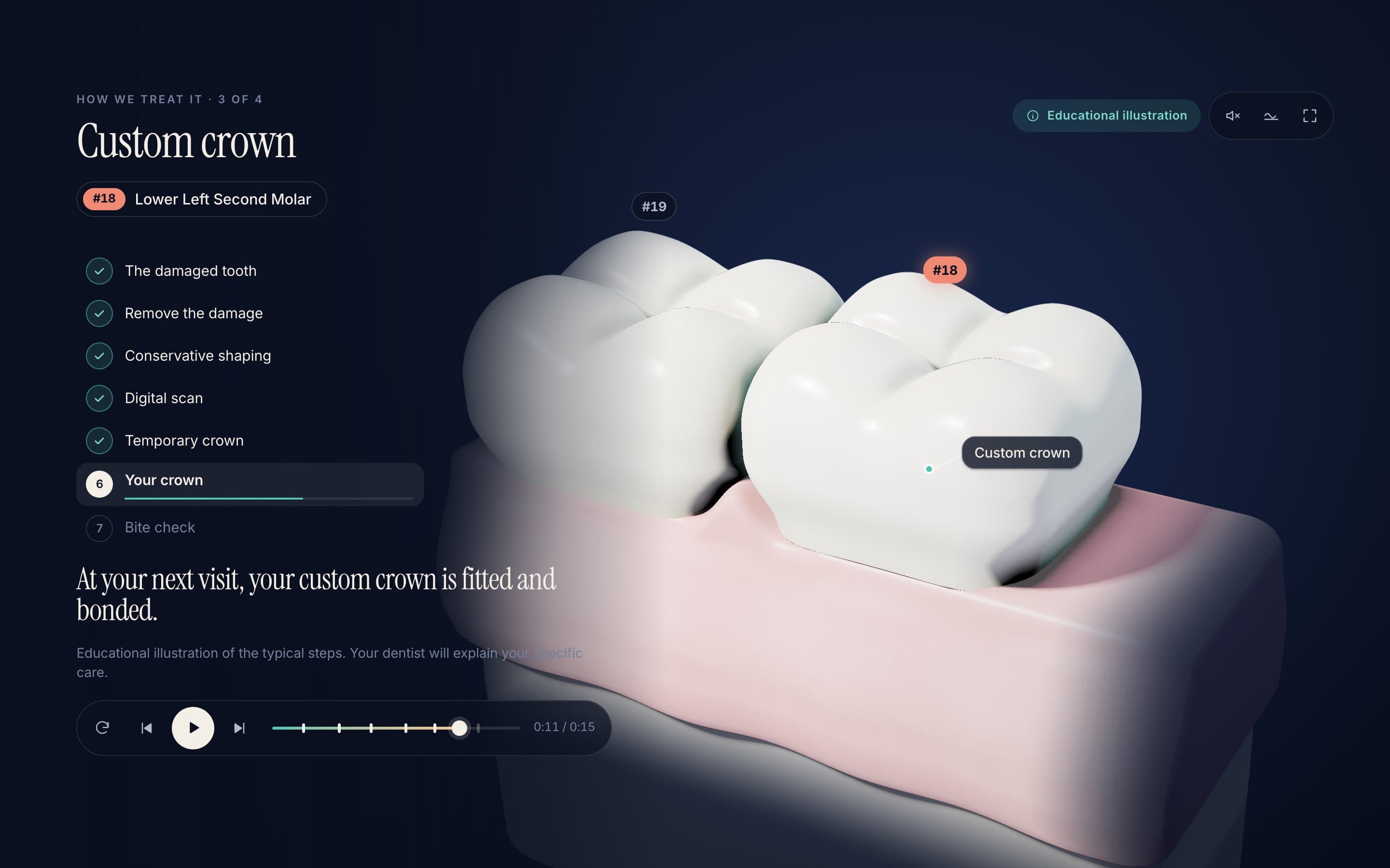 Crown — The final crown seats onto the prepared tooth.