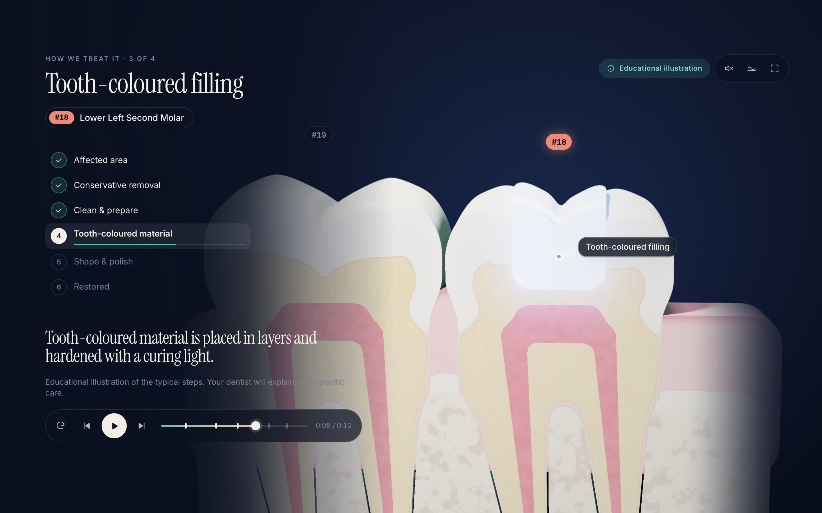 Filling — Decay removed conservatively, then rebuilt in tooth-coloured layers.